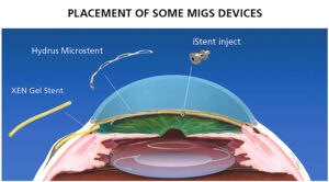 MIGS Glaucoma Surgery devics and their placement in the eye. Am I at rish for Glaucoma? Find out at Vantage Eye Center