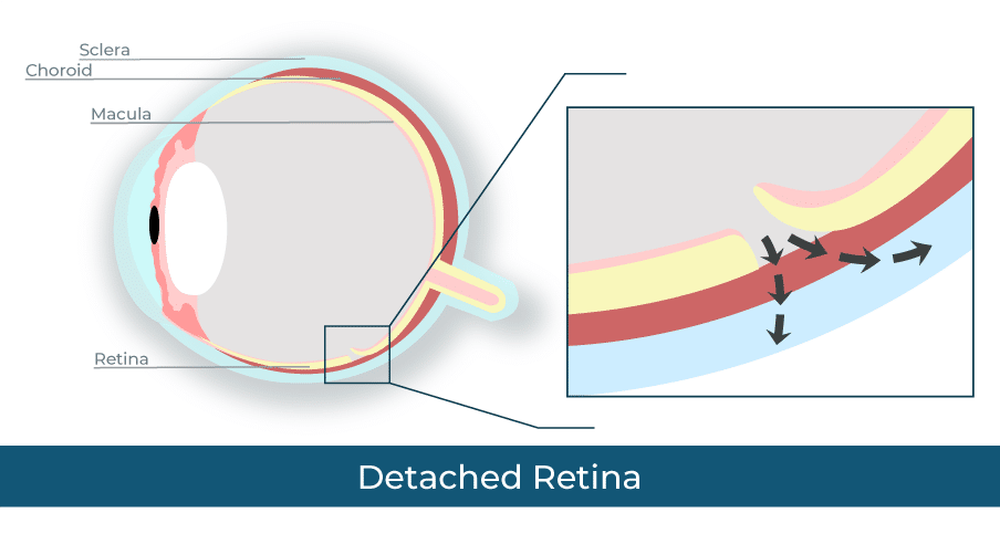 Retinal detachment rendering