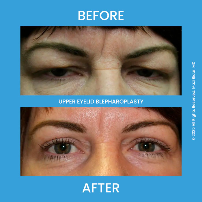 Patient before and after upper eyelid surgery.