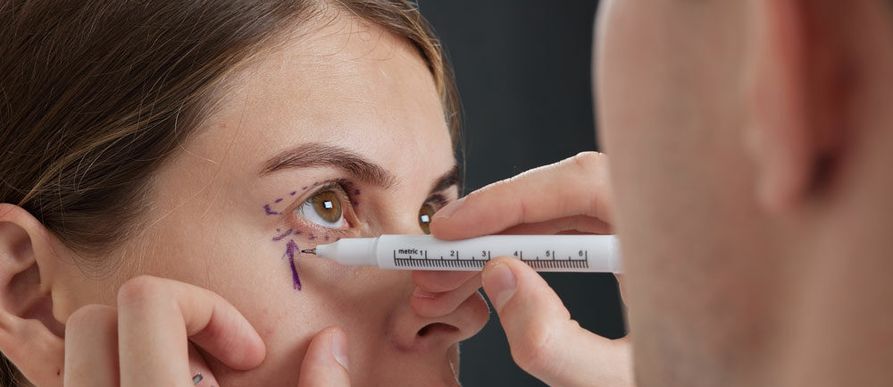 Image of a doctor making markings during a consultation for blepharoplasty.  