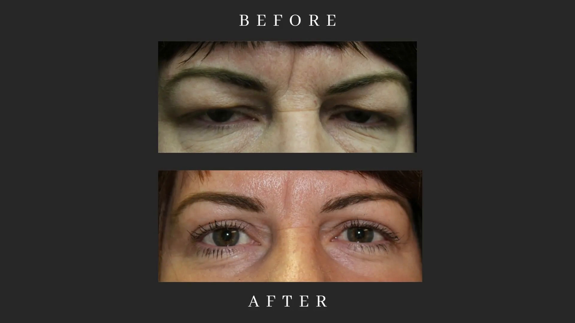 Before and After of Dr. Bidar's brow pexy patient.