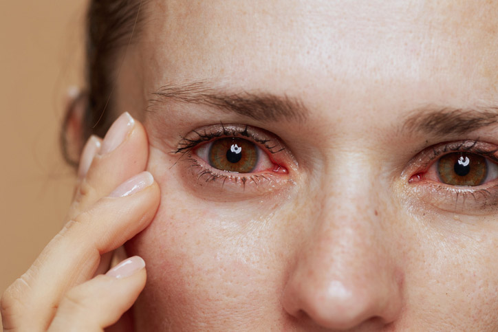 Woman experiencing eye pain and redness, a potential eye emergency requiring urgent evaluation.