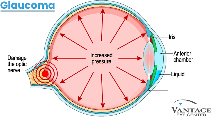 Diagram of an eye showing increased intraocular pressure pushing outward and causing optic nerve damage, illustrating how glaucoma develops. Labels identify the iris, anterior chamber, and fluid buildup.