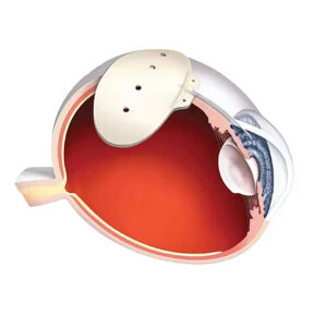 Baerveldt Tube Shunt used at Vantage Eye Center