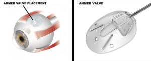 traditional glaucoma devices Ahmed valve diagram showing Ahmed valve placement on the eye and close up of the Ahmed glaucoma valve at Vantage Eye Center
