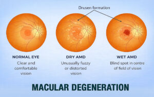 living with macular degeneration infographic showing a normal eye, dry AMD with drusen formation, and wet AMD with a central blind spot at Vantage Eye Center