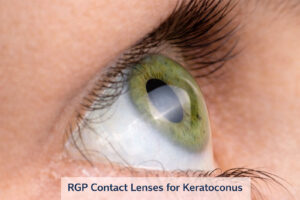 Specialty Contact Lenses like this RGP lens helps correct issues with Keratoconus are available through Vantage Eye Centers