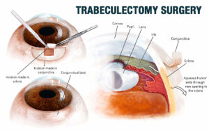 traditional glaucoma devices trabeculectomy surgery diagram showing incisions conjunctival bleb and aqueous humor drainage at Vantage Eye Center