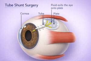 traditional glaucoma devices tube shunt surgery diagram showing cornea iris tube and plate at Vantage Eye Center