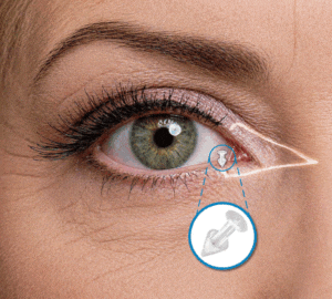 Close-up of a woman's eye and where Punctal Plugs are inserted into the eye, used at Vantage Eye Center in Monterey and Salinas, California.